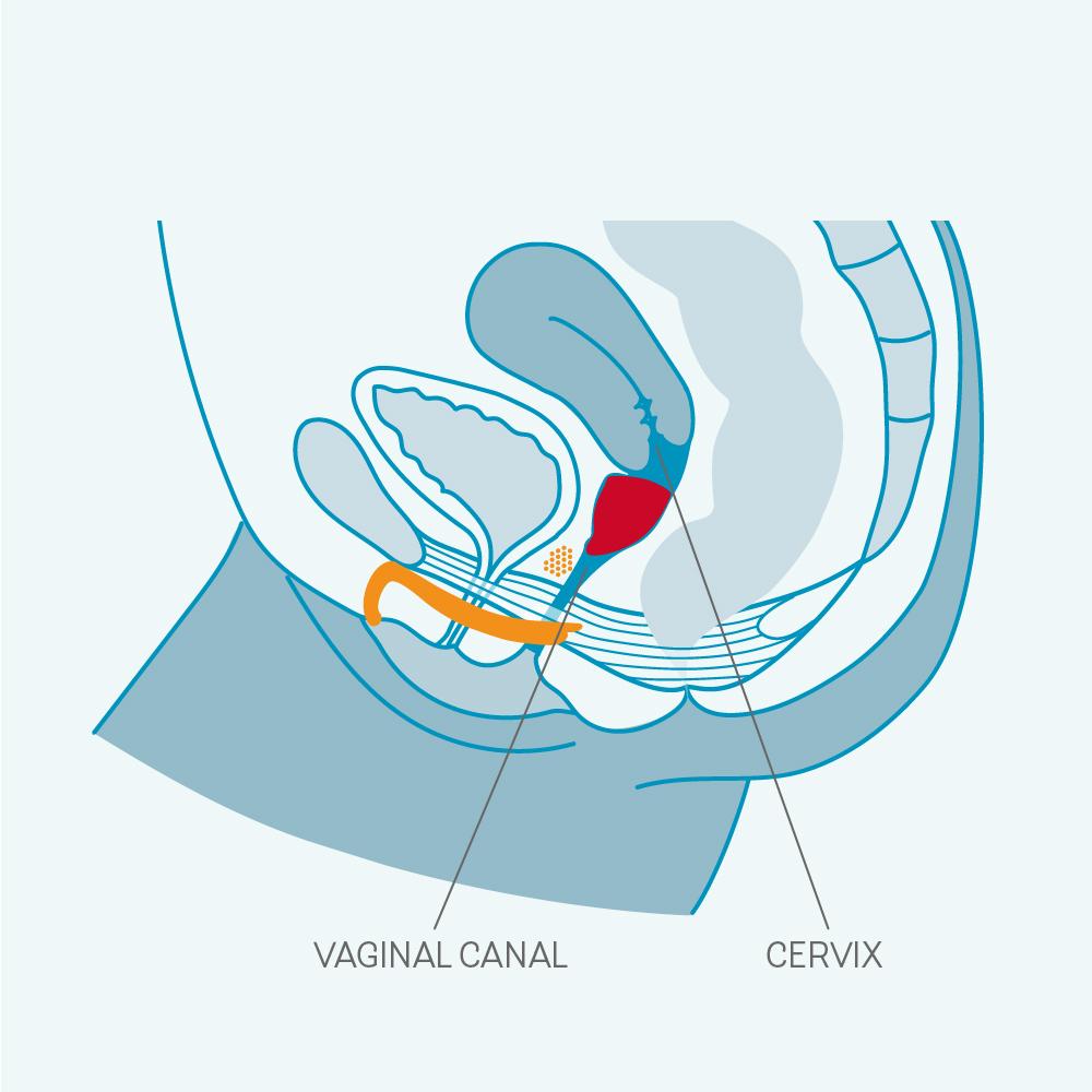 Diagram of the female reproductive system highlighting the cervix and vaginal canal.